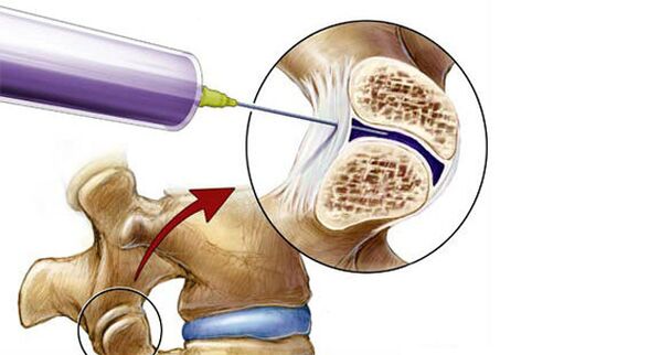 Sırt ağrısı için paravertebral blok